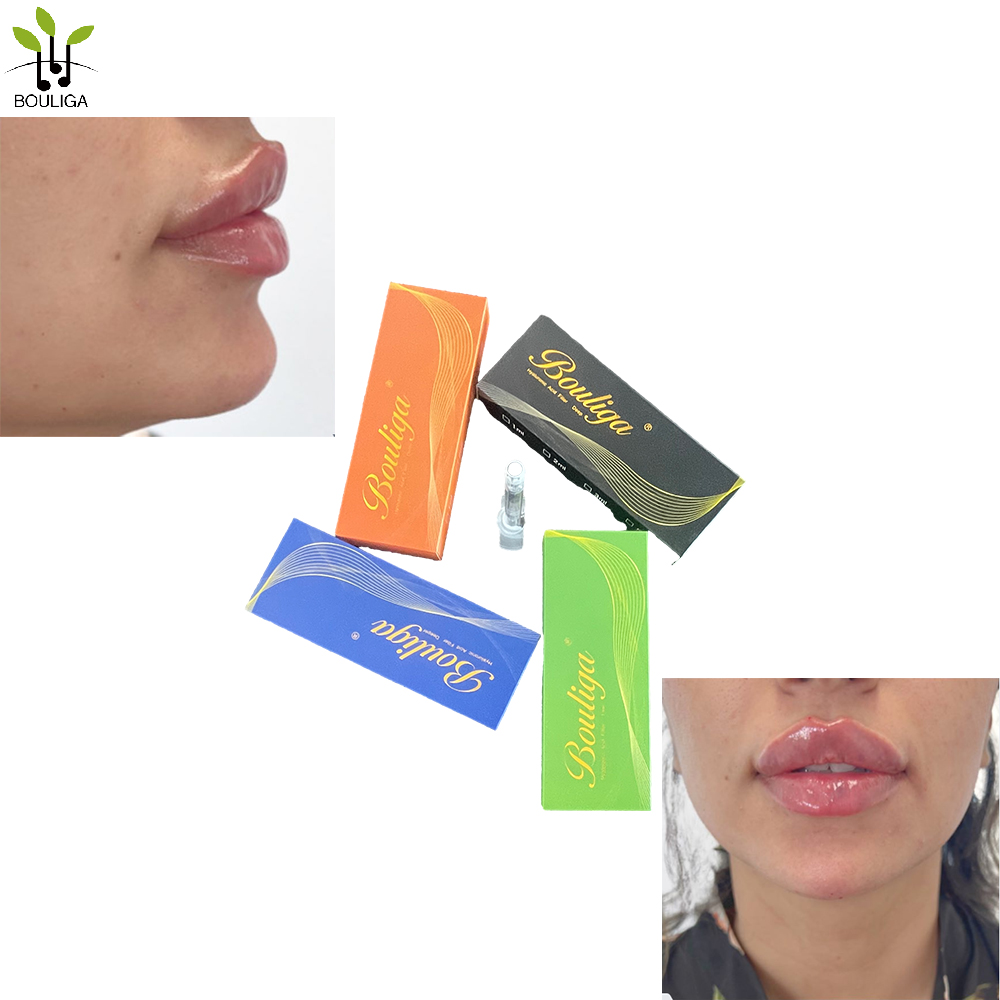 Bouliga 100% pure Hyaluronci Acid Dermal Filler 2ml 24mg/ml high Concentration for Lip no pain 