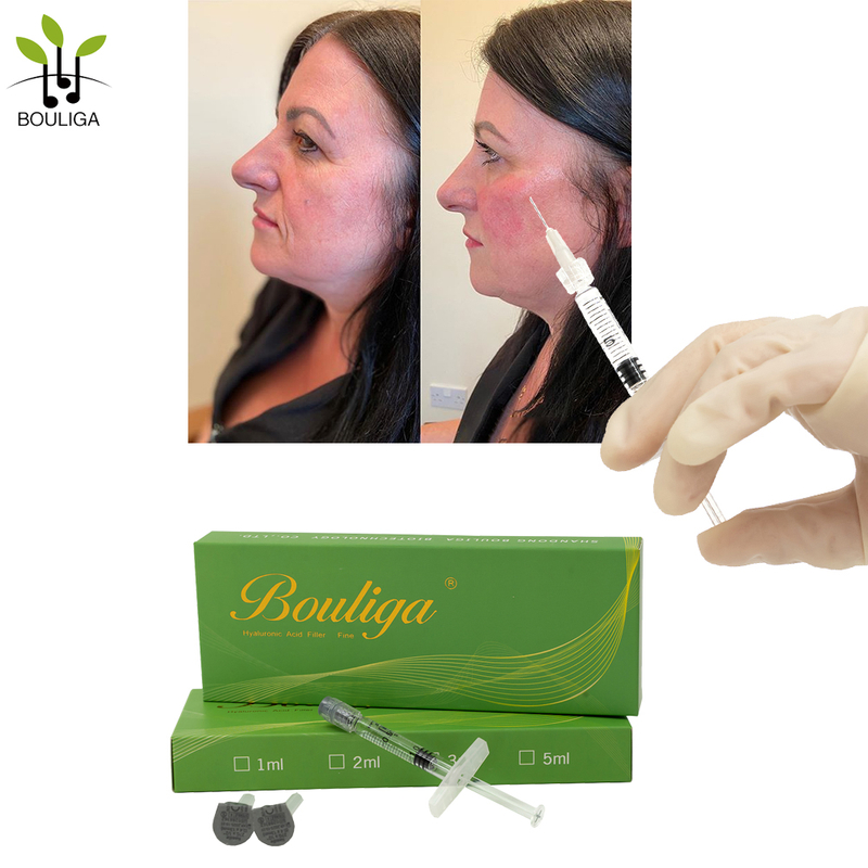 Tear Trough Correction Rejuvenation Facial Fillers