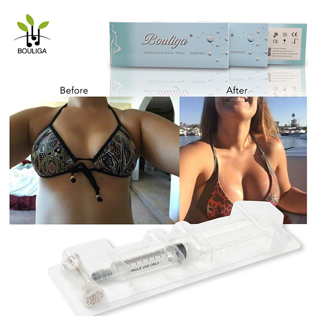 Body Filler ,Hyaluronic Acid Dermal Filler 