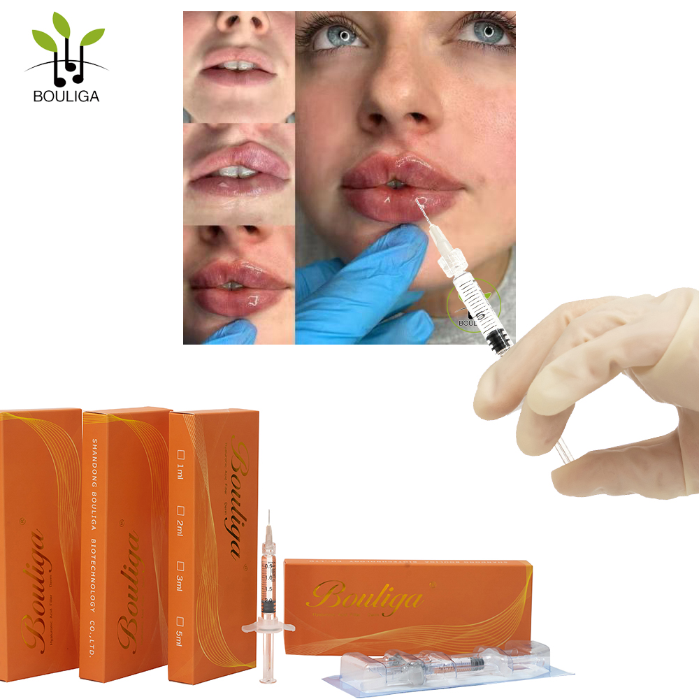 Bouliga 1ml 2ml 5ml 10ml Long-laster Dermal Filler for Lips