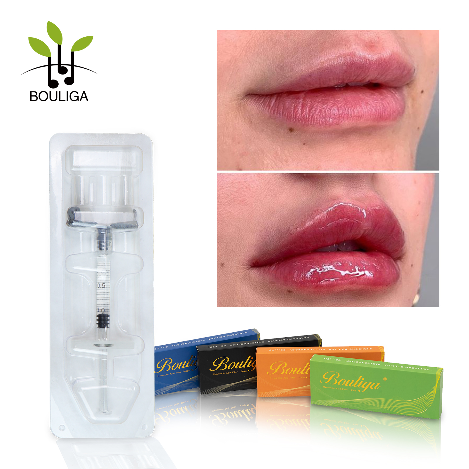 Lip Augmentation Filler Hyaluronic Acid Dermal Injection
