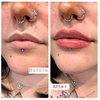 Injectable1ml 2ml 3ml 5ml Crosslinked Hyaluronic Acid Injecions Dermal Filler/Ha Filler for Lips, Nose, Wrinkles, Breast, Buttocks, Body, Face, Neck, Folds