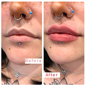 Injectable1ml 2ml 3ml 5ml Crosslinked Hyaluronic Acid Injecions Dermal Filler/Ha Filler for Lips, Nose, Wrinkles, Breast, Buttocks, Body, Face, Neck, Folds