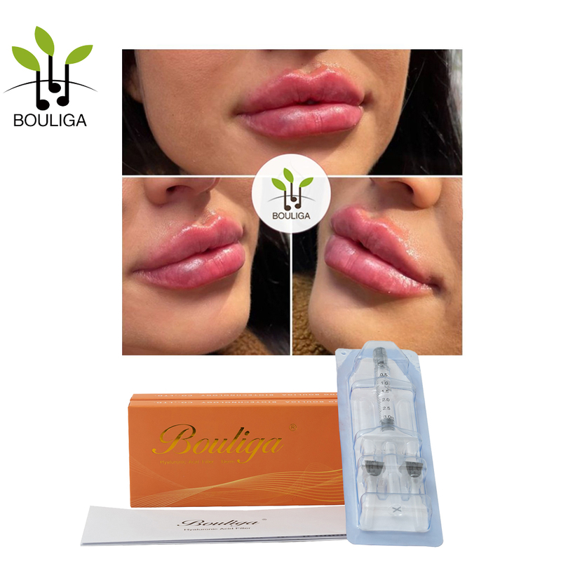 Lip Augmentation Volume Restoration Facial Fillers