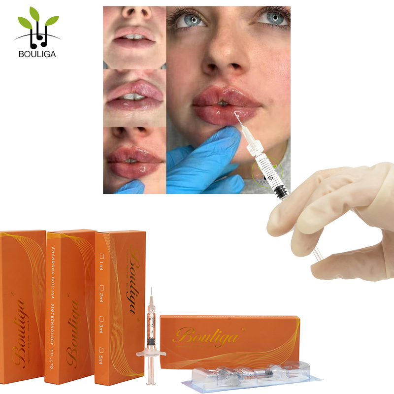 Bouliga Non-surgical Enhance Lips Filler 5ml Dermal Filler Non-Surgical 